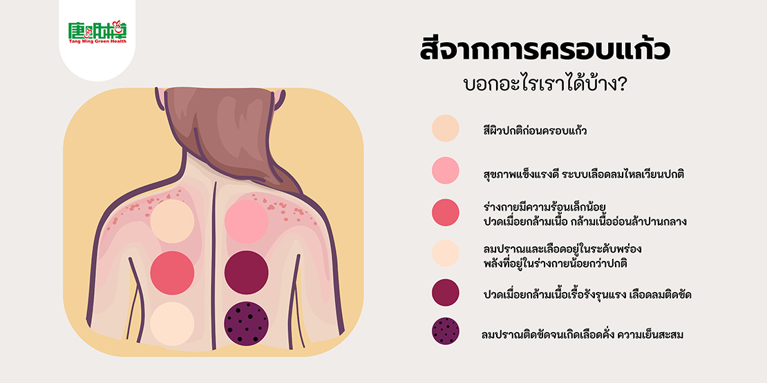 การครอบแก้ว (Cupping)